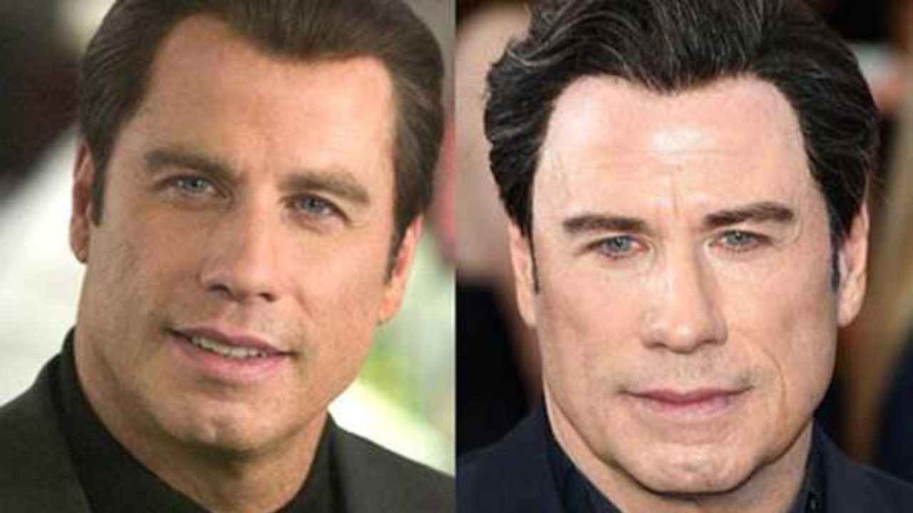 john travolta plastic surgery