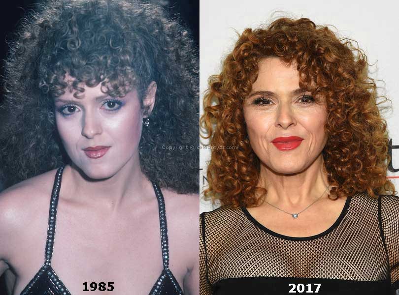 bernadette peters plastic surgery