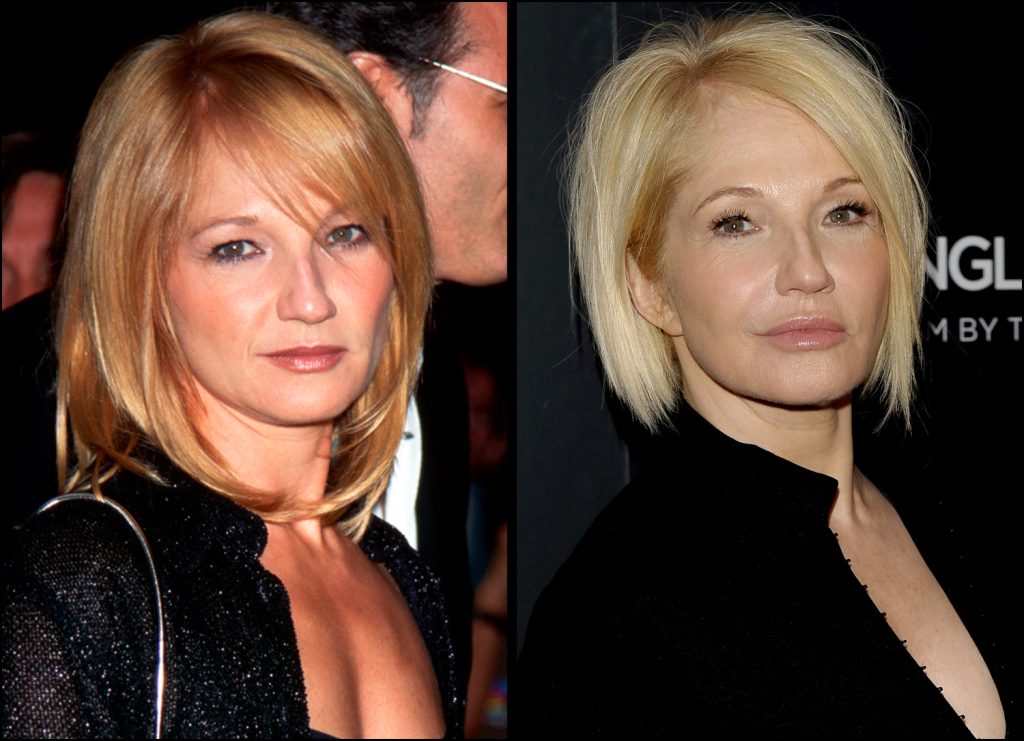 Ellen Barkin's Plastic Surgery